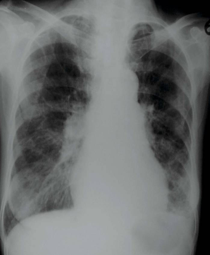 慢性肺原性心脏病